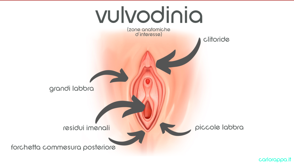 Vulvodinia Milano dott.ssa Cristina Passadore