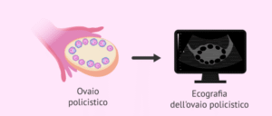 Sindrome dell'Ovaio Policistico (PCOS): Impatto sulla Fertilità Milano dott.ssa Cristina Passadore
