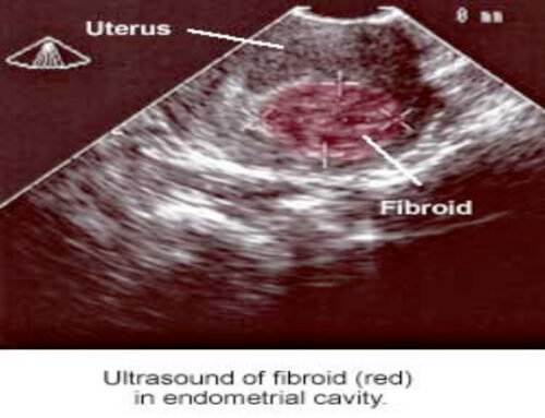 Polipi Uterini e Cervicali: Bisogna Sempre Toglierli? L’Isteroscopia